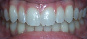 ClearCorrect Aligners After Photo - Front View