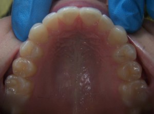 ClearCorrect Aligners After Photo - Bottom View