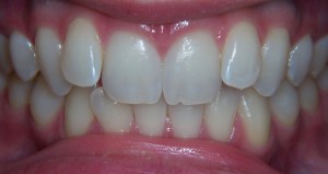 ClearCorrect Aligners Before Photo - Front View