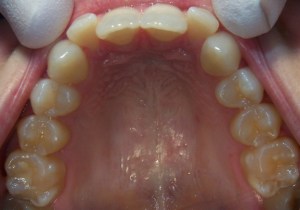ClearCorrect Aligners Before Photo - Bottom View