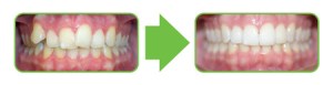 Example of Clear Braces Correcting Overcrowded Teeth
