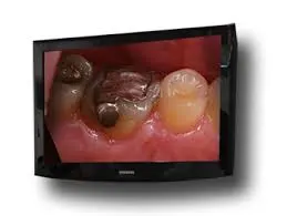 Apple Monitor showing Old crown on a patient