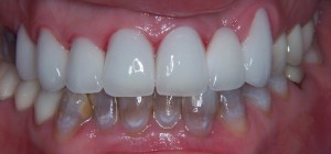 Porcelain Veneers after photo