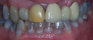 Porcelain Veneers before photo