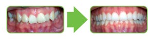 Example of an Overbite Correction