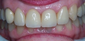 Smile Gallery Case 18 After Crowns Replaced Photo