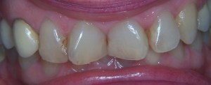 Smile Gallery Case 18 Before Photo