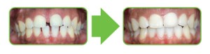 Example of Clear Braces before and after