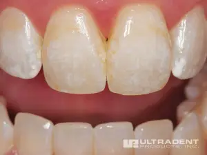 Opalustre-Before