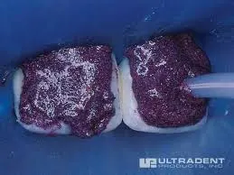 Micro-Abrasion being performed