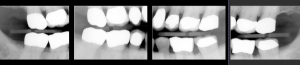 Dental xray