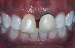 Dental Crowns Before Photo