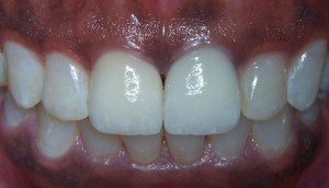 Dental Crowns Before Photo