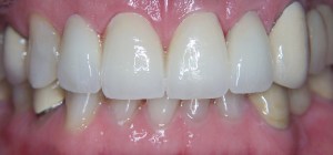 Smile Gallery Case 9 After 4 Upper Porcelain Veneers