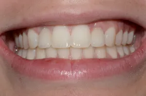 Dental Implants After Photo