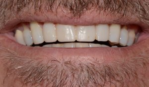 Smile Gallery Case 10 Photo During Treatment with temporary crowns