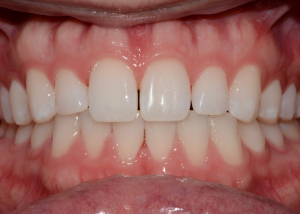 Smile Gallery Case 19 Before Photo