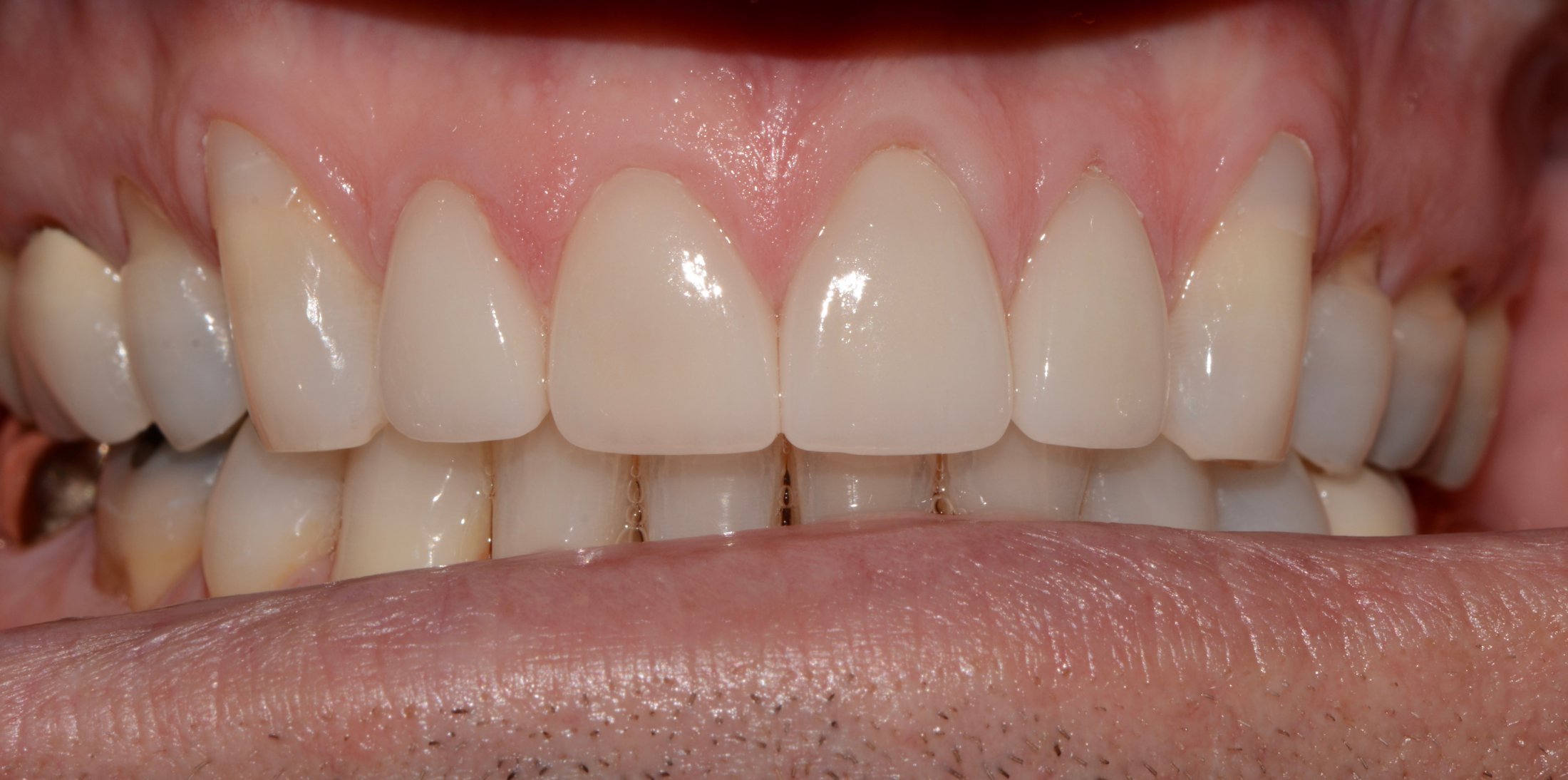 Porcelain Crowns and Gum Grafting