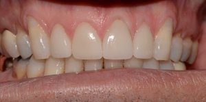 Smile Gallery Case 10 After Porcelain Crowns and Gum Grafting Photo