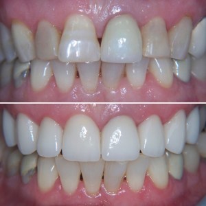 Case 16 Before and After photos- all upper porcelain veneers
