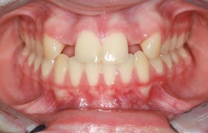 Dental Implants Before Photo