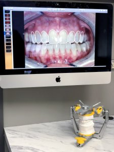 closeup of teeth on computer monitor