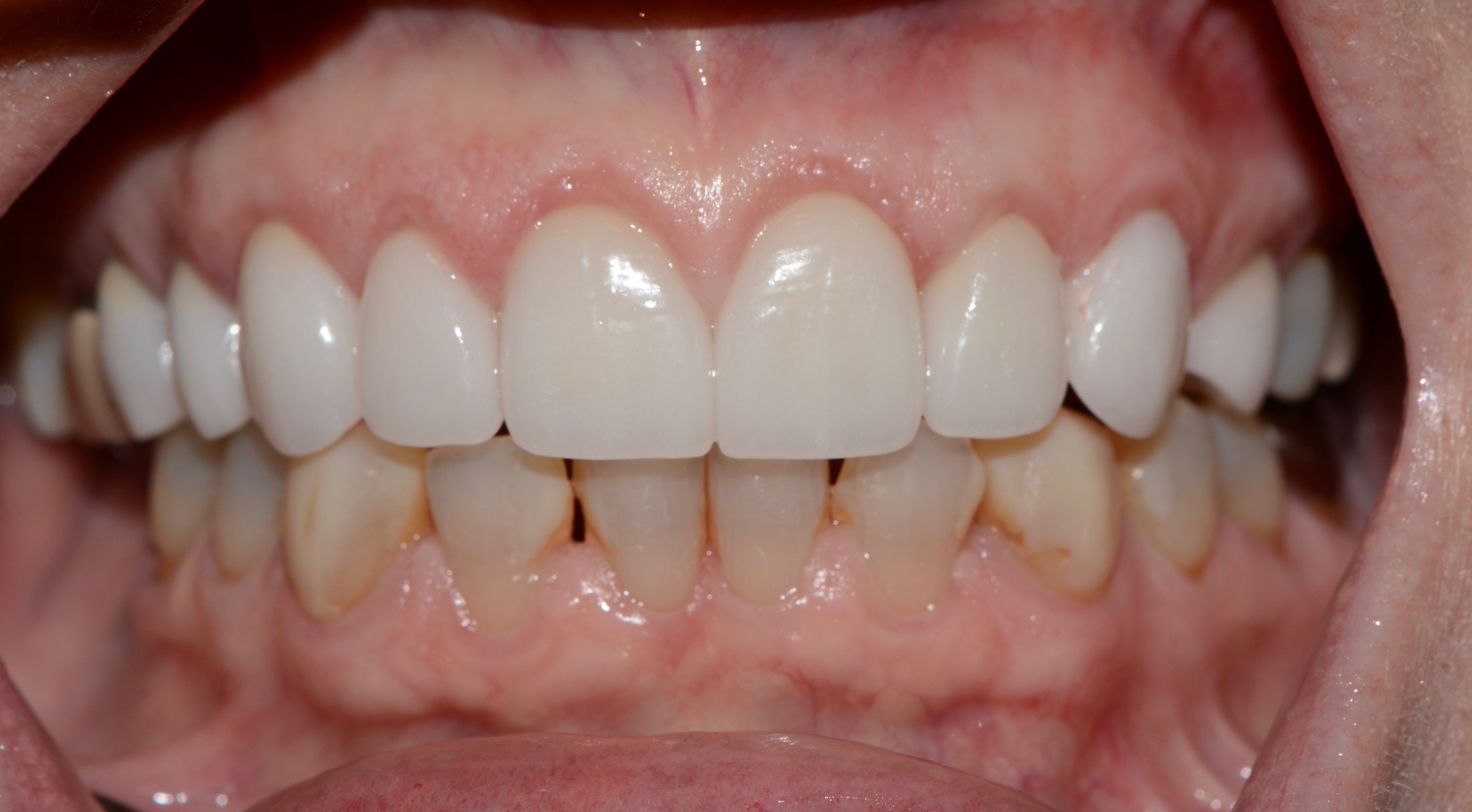 Upper Dental Crowns