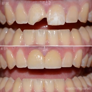 Smile Gallery Case 1 Before and After Photo