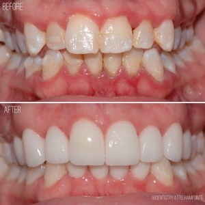 Smile Gallery Case 2 Before and After Photo