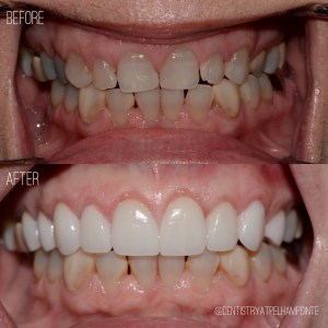 Smile Gallery Case 3 Before and After Photo