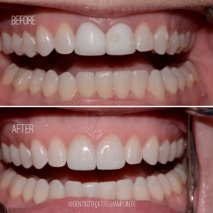 Smile Gallery Case 5 Before and After Photo