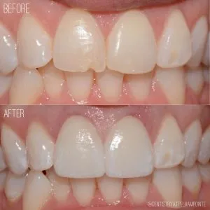 Smile Gallery Case 4 Before and After Photo