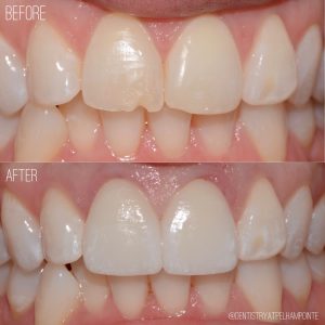 Smile Gallery Case 4 Before and After Photo