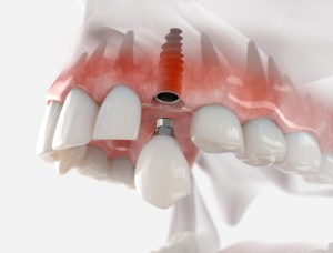 Dental Implant graphics