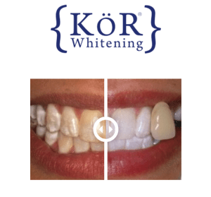 KoR Whitening before and after