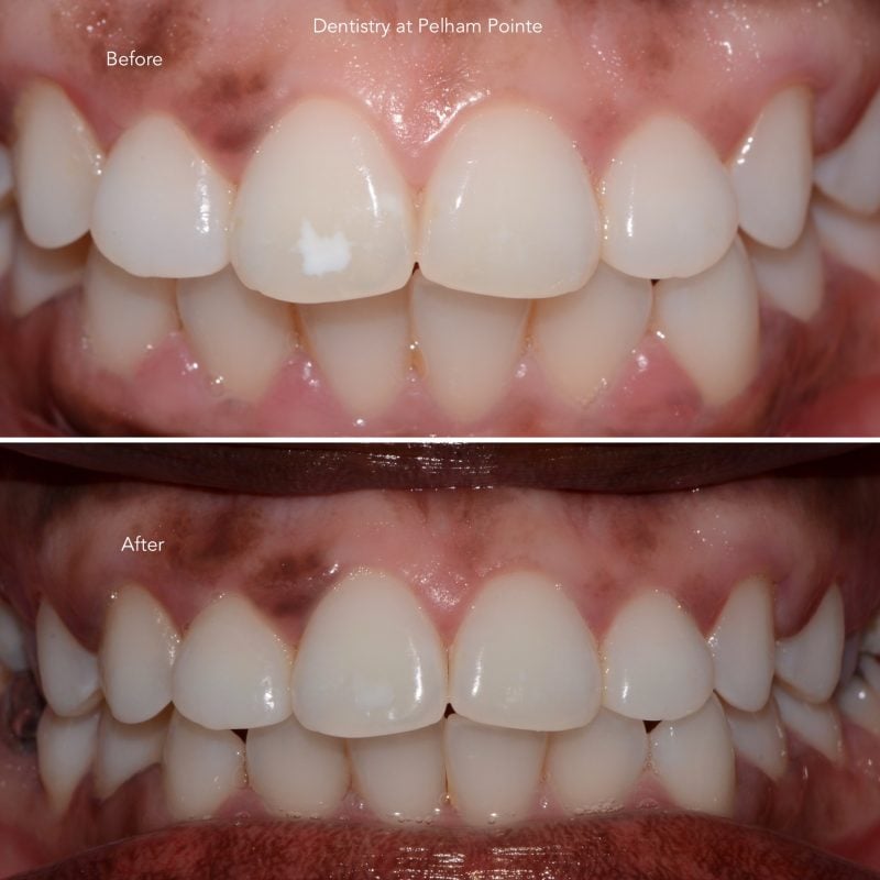 Micro-abrasion and whitening
