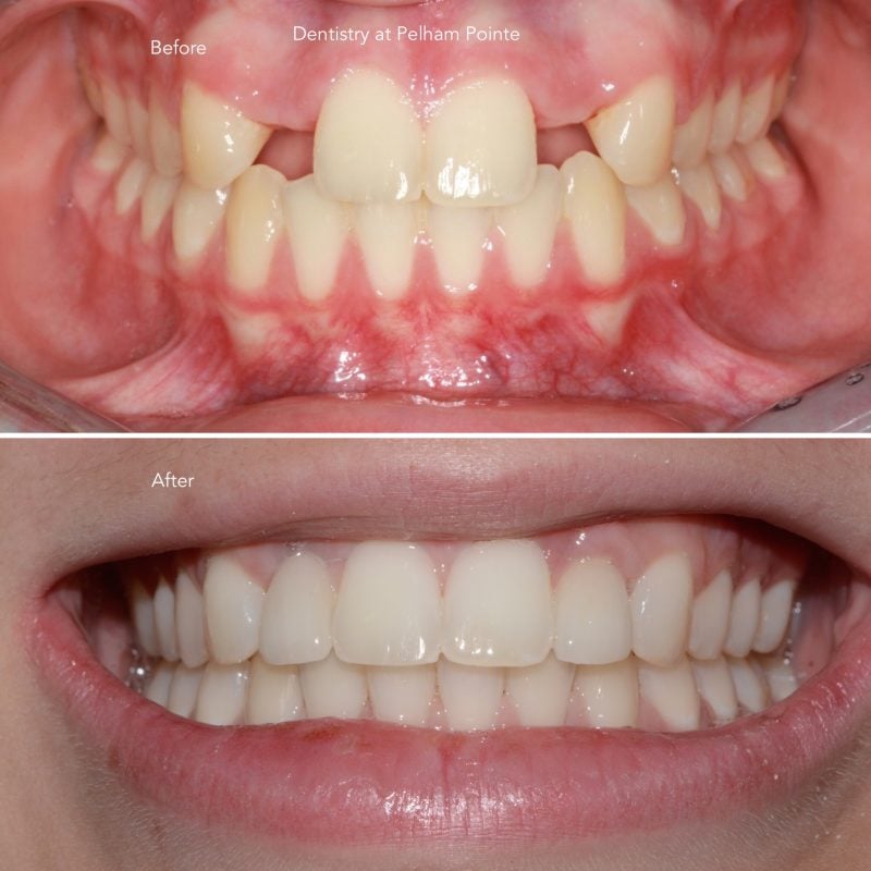 Upper anterior implant crowns