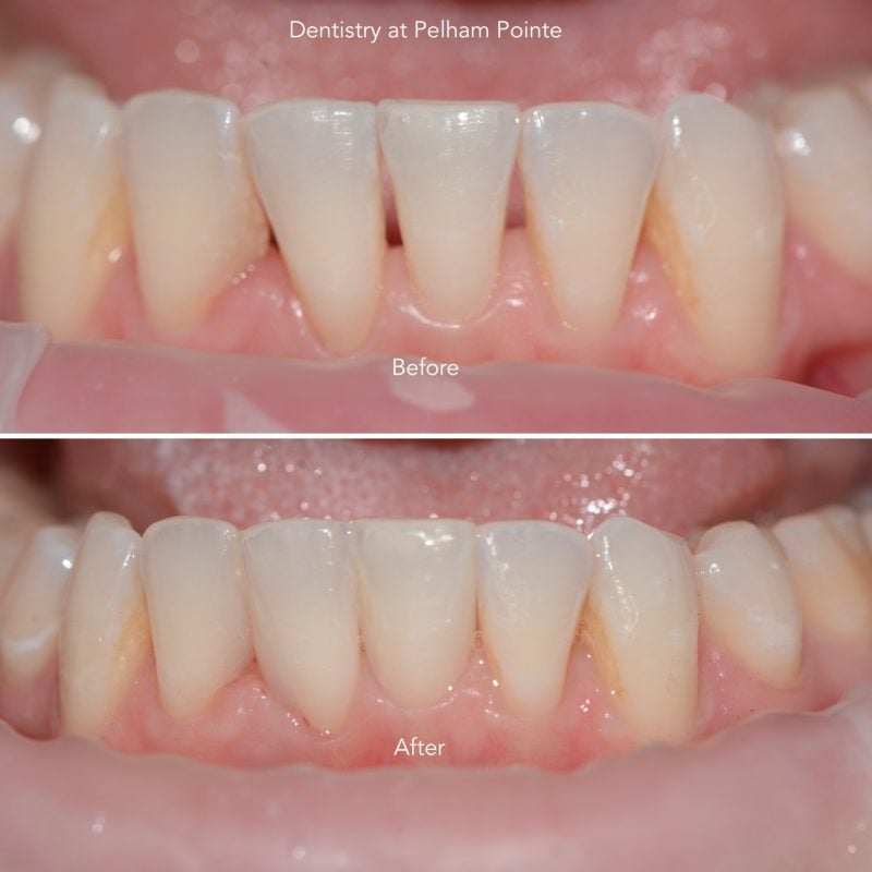 Before and after photos of Composite resin bonding to close spacing