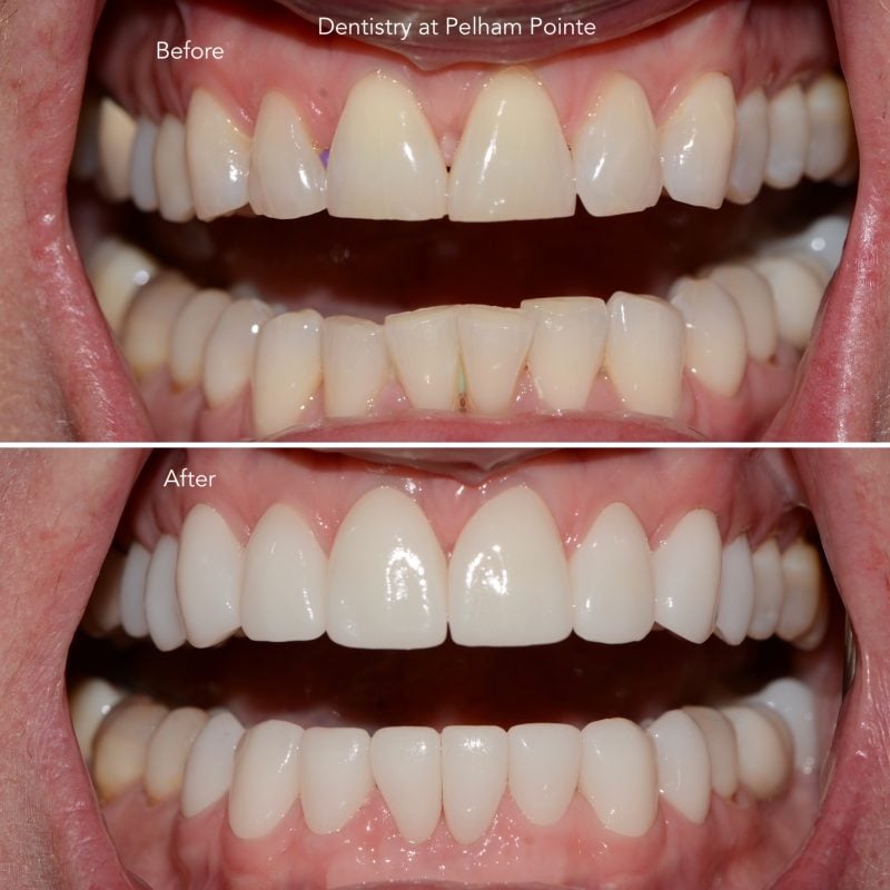 Before and After photos of Anterior Crowns on the upper and lower front teeth