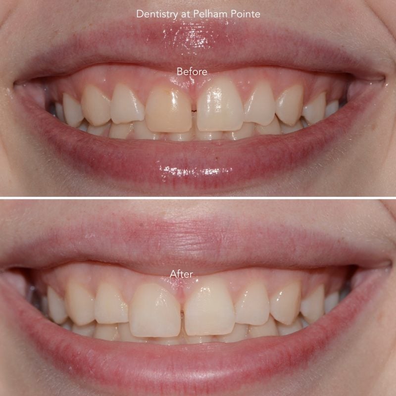 Before and After photos of Discolored composite resin bonding replaced on front tooth