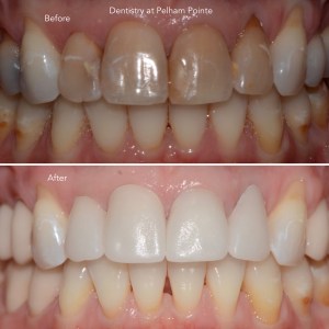 Before & After Smile Gallery