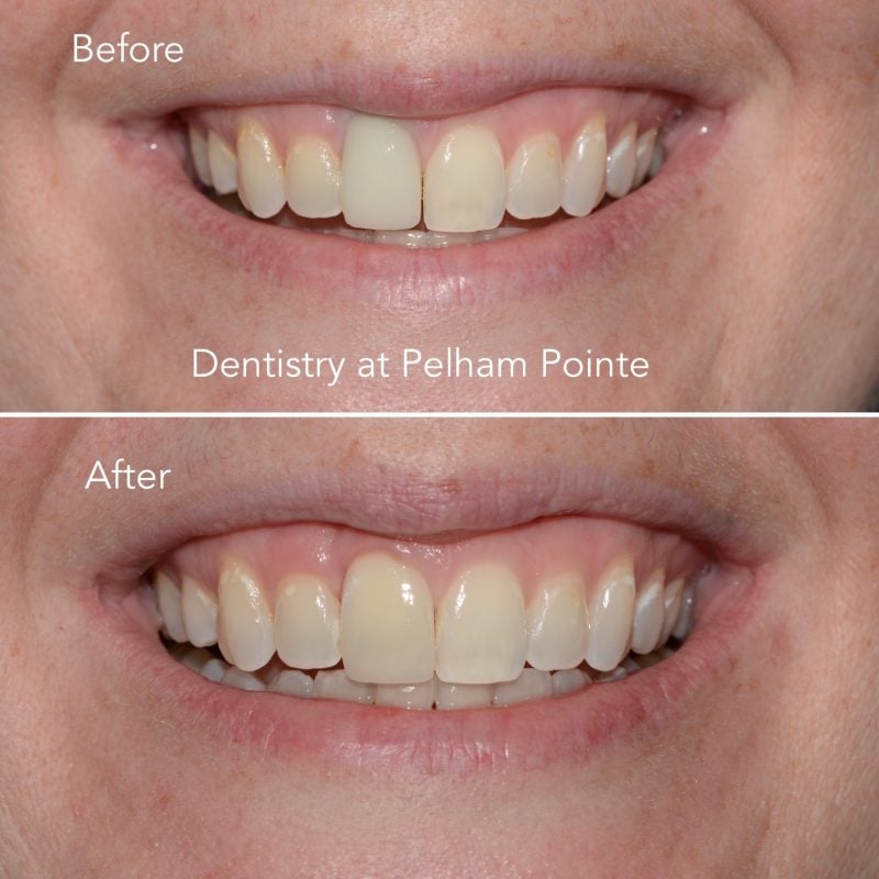 Replacement of discolored implant crown ( by previous dentist)