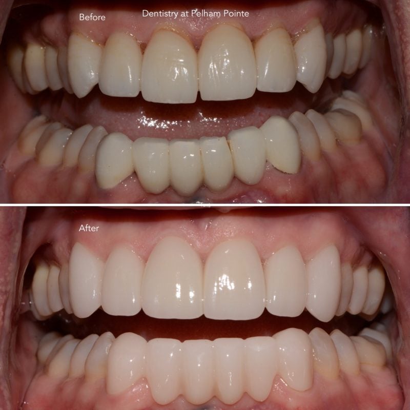 Anterior porcelain crowns and bridge