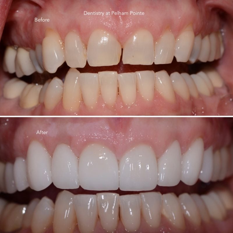 Anterior porcelain crowns